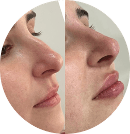 Preenchimento Facial