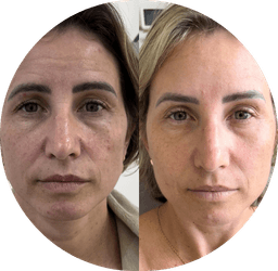 Bioestimuladores de colágeno